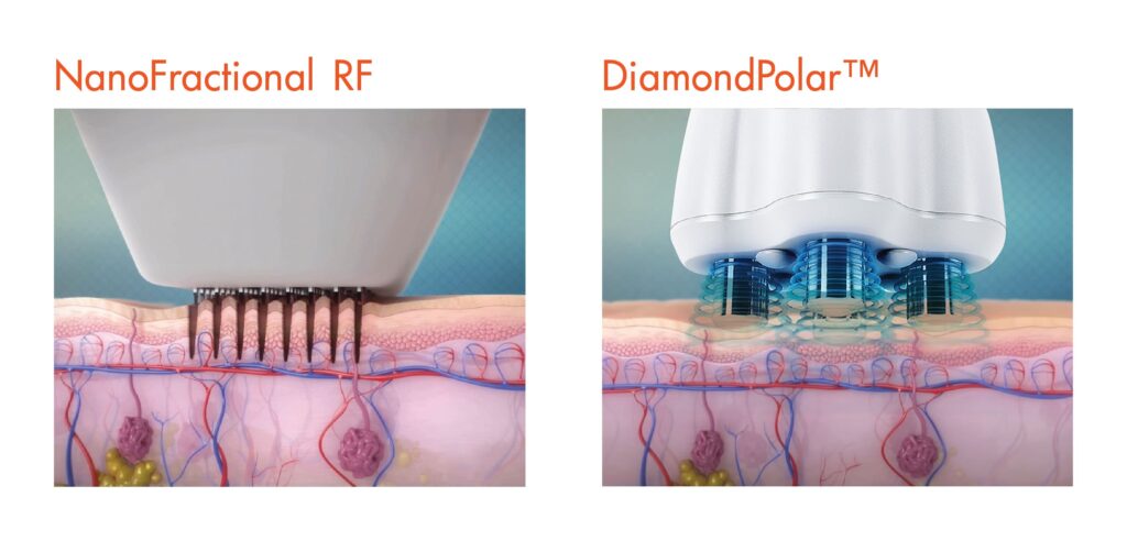 เครองรกษาหลมสว Venus Viva MD นวตกรรม NanoFractional RF