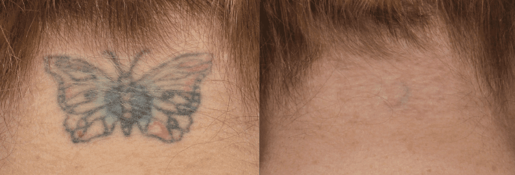PicoSure Tattoo removal