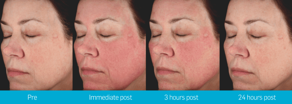 Picosure treatment