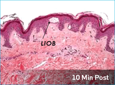 Picosure laser