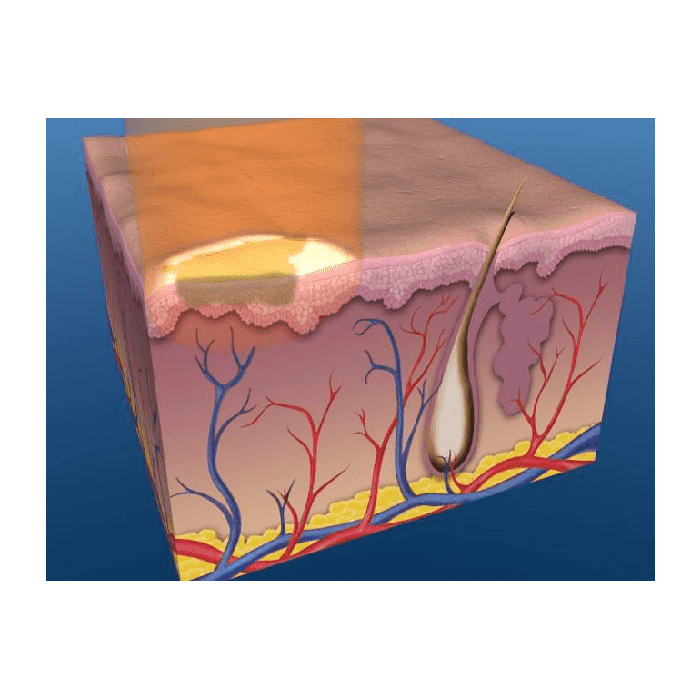 Pigmented-Lesions