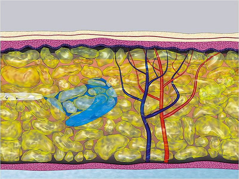 Infiltration of analgesics and adrenaline