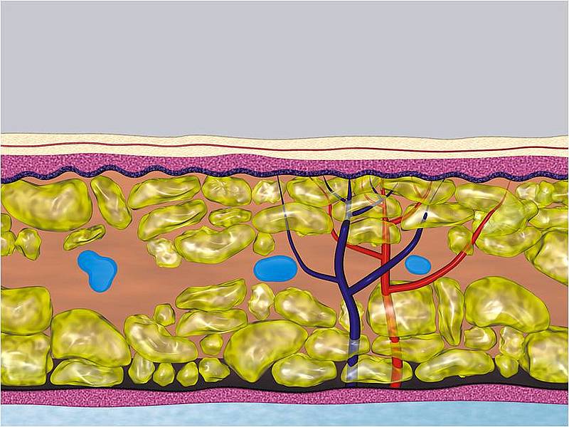 Homogeneous Structure, less trauma, minor residuals