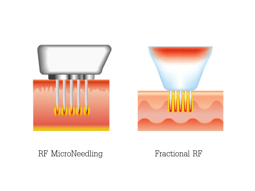 RF Microneedling VS Fractional RF