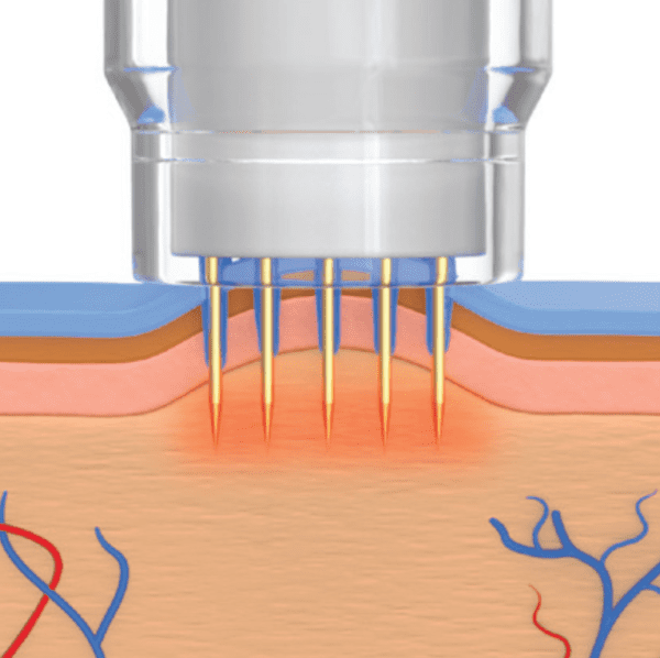 Potenza - The world’s first 4-mode RF Microneedling device