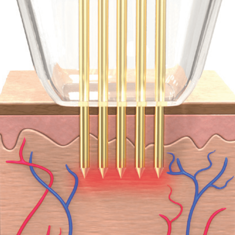 Potenza - Insulated needles