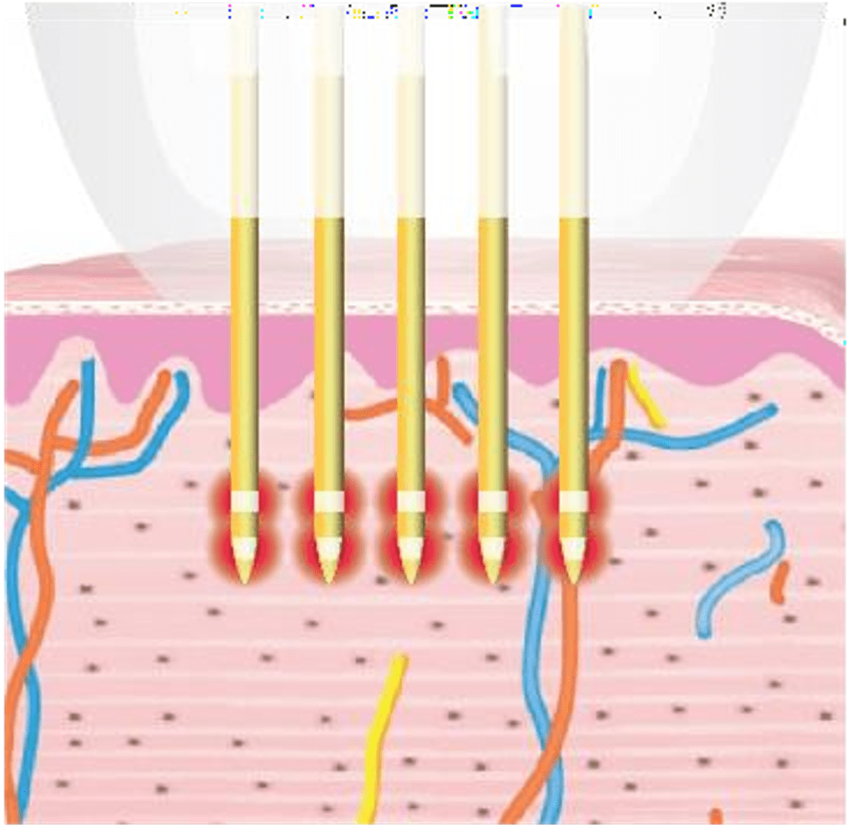 Potenza RF MICRONEEDLING treatment