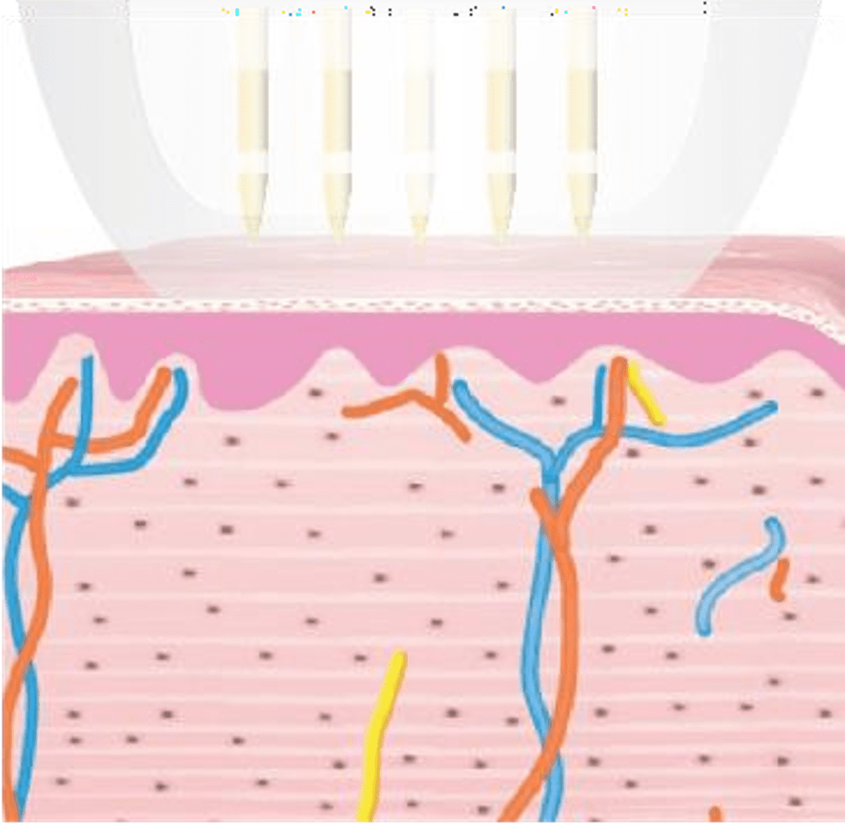 Potenza RF MICRONEEDLING treatment