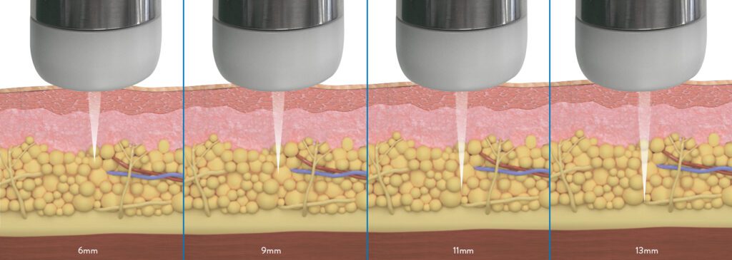CFU-ÈLIFE, Hyperhidrosis therapy, non-surgical face lift andreduction ...