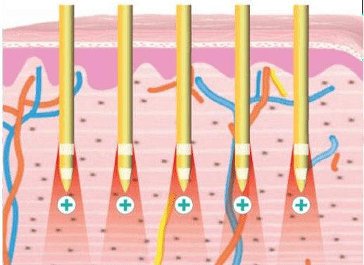 Bipolar RF