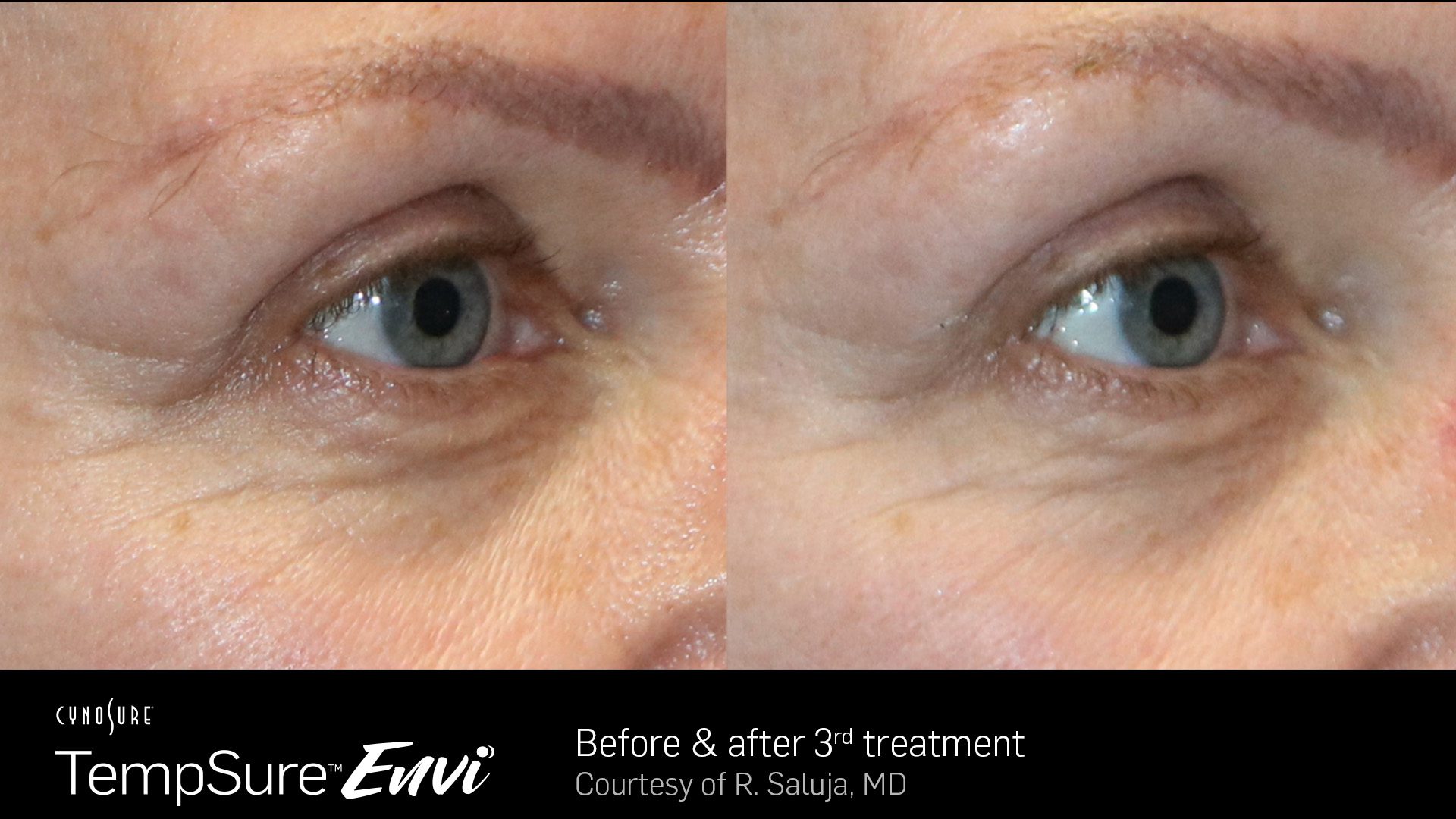 TempSure Envi B&A 17