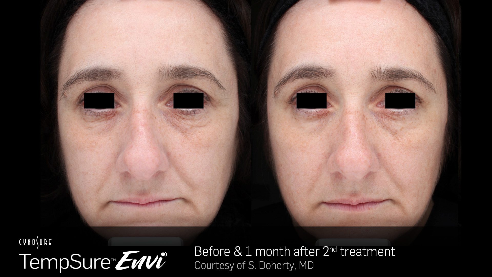 TempSure Envi B&A 2