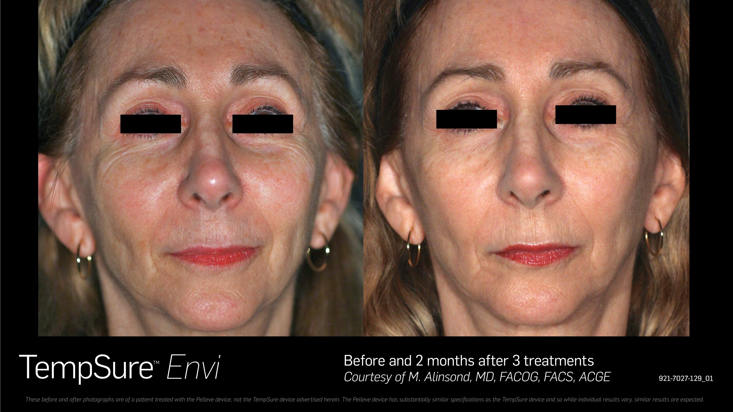 TempSure Envi B&A 20