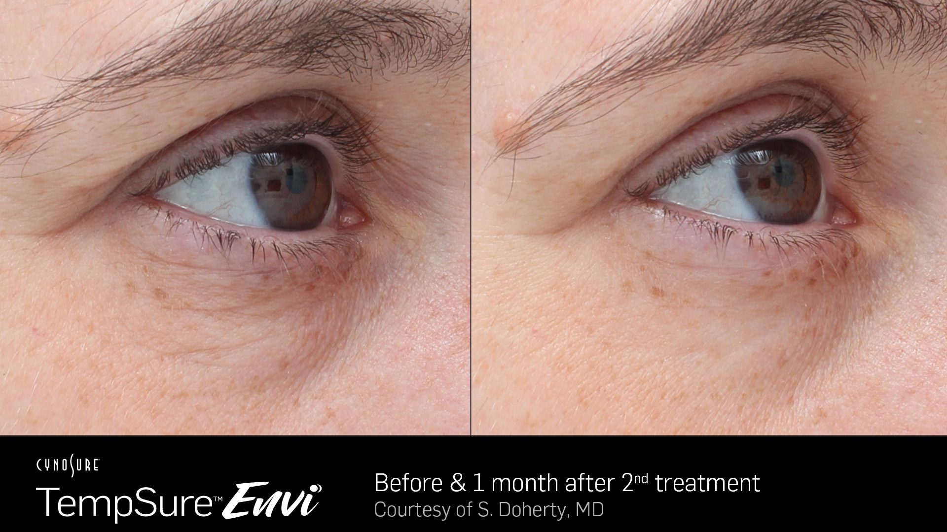 TempSure Envi B&A 2B