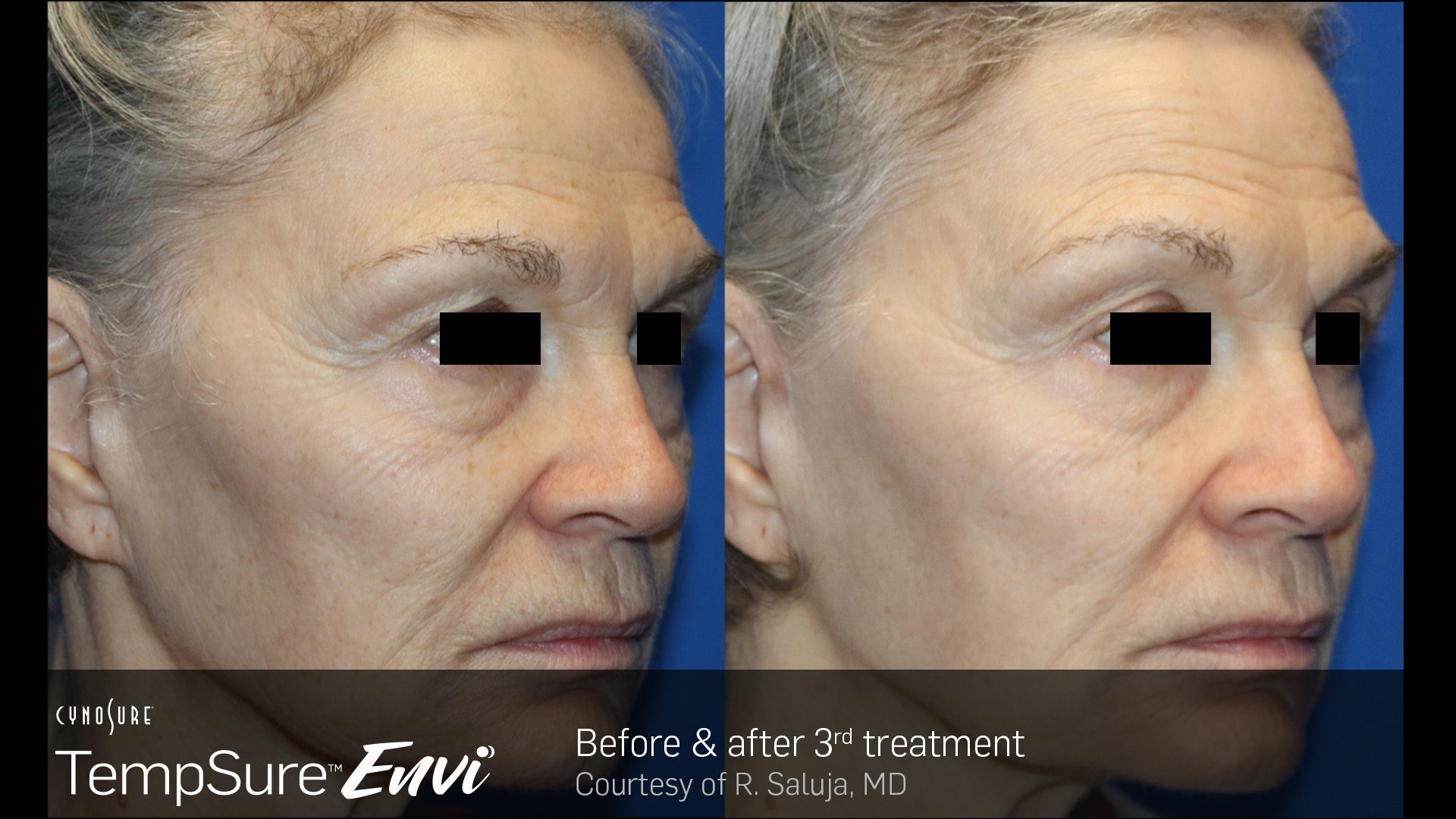 TempSure Envi B&A 5