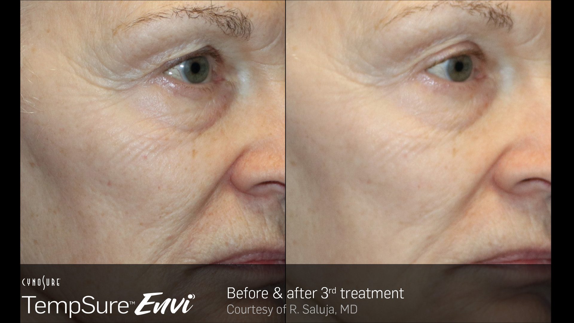 TempSure Envi B&A 5B