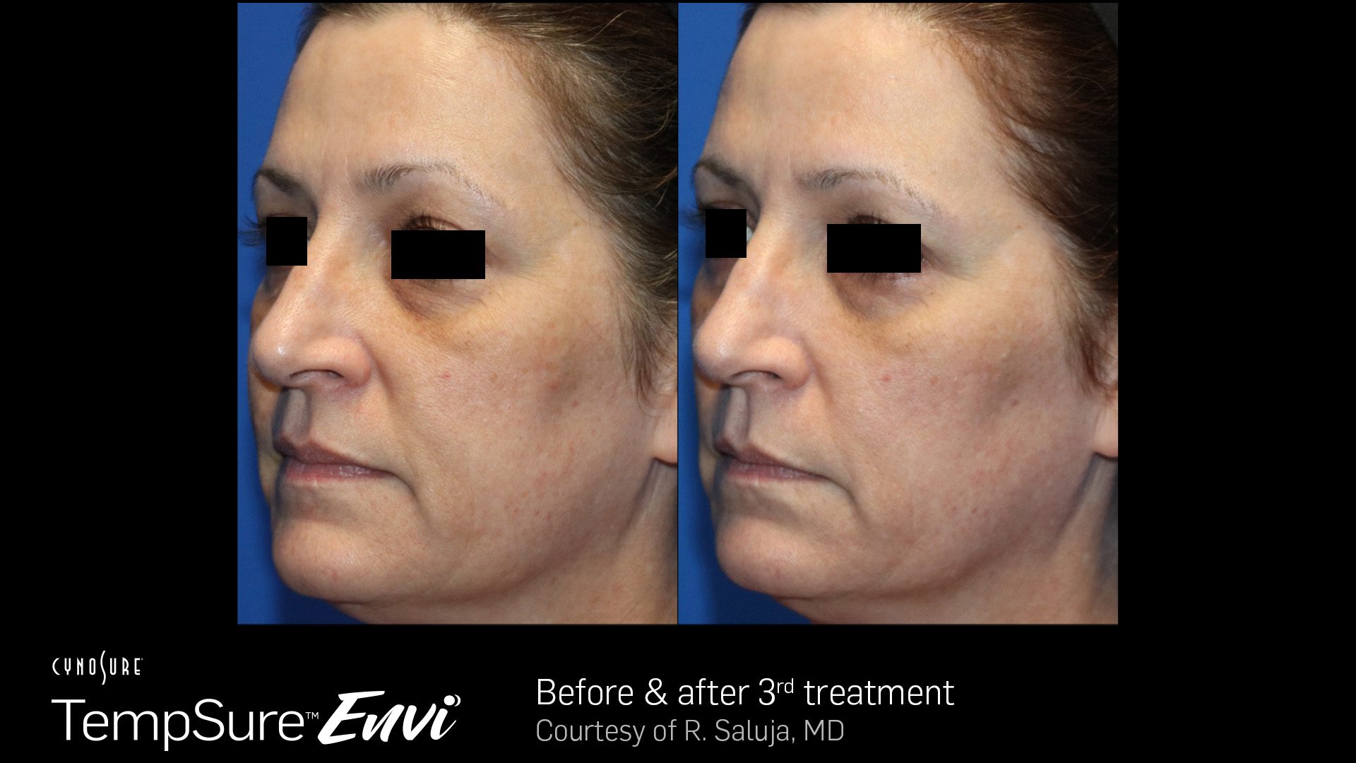 TempSure Envi B&A 7