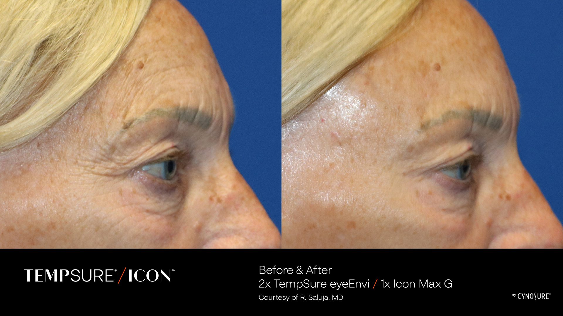 TempSure Envi Icon Combo B&A 2